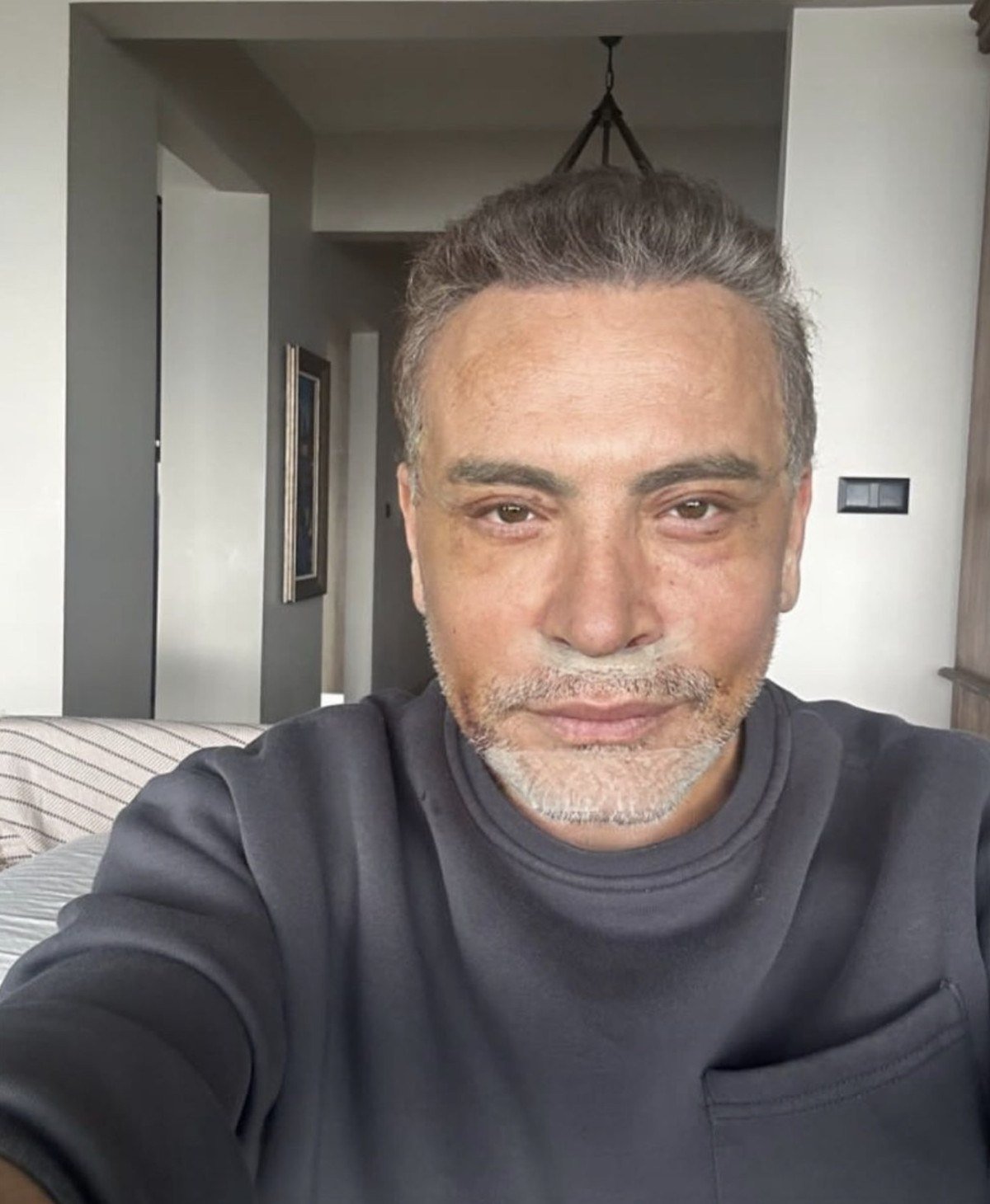erkeklerde estetik furyasi cenk eren de yuzunu gerdirdi 0 8XO3f8vu