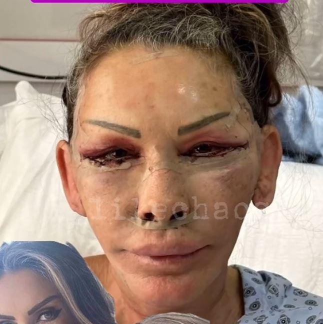 petek dincozun annesi de estetik akimina uydu yuzunun son hali herkesi sasirtti 2 3fmPpFDs