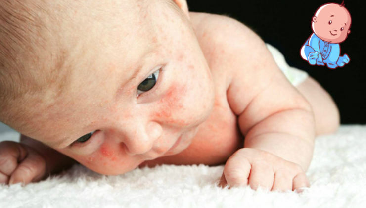 Bebeklerde isilik neden olur? Bebeklerde isiliğe ne iyi gelir? 2024 en iyi isilik kremleri